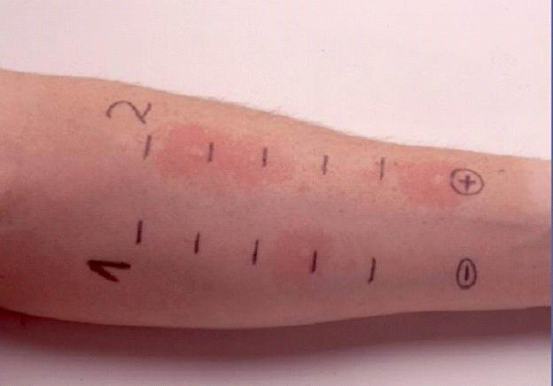 皮肤点刺实验是将少量高度纯化的致敏原液体滴于患者前臂,再用点刺针